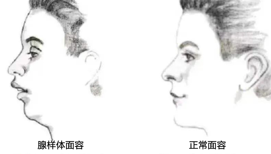01 什么是腺樣體面容？.png
