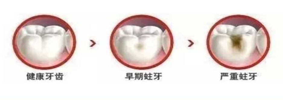 06 補(bǔ)牙為什么要趁早？.png