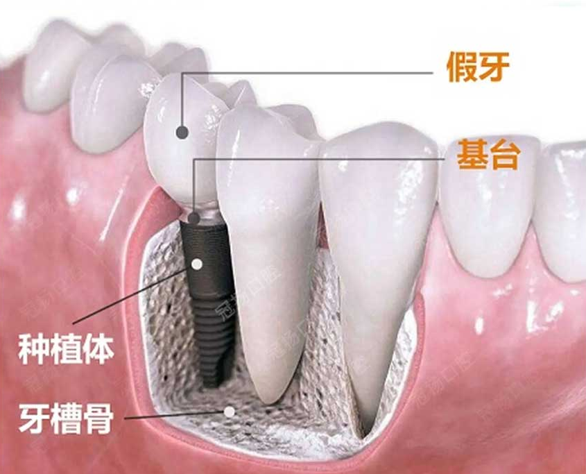 01 為啥現(xiàn)在缺牙都做種植牙？.png